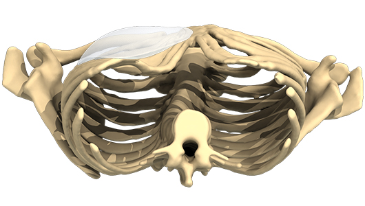 Vista de ángulo bajo en 3D de un implante para tratar un tórax en embudo Vista de ángulo bajo en 3D de un implante para tratar un tórax en embudo