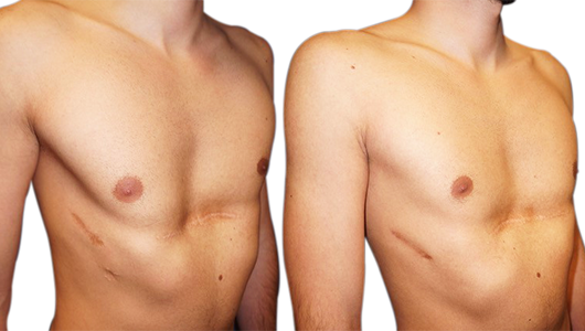 Foto antes/después de la revisión de Nuss y Ravitch con la técnica de los implantes 3D a medida Foto antes/después de la revisión de Nuss y Ravitch con la técnica de los implantes 3D a medida