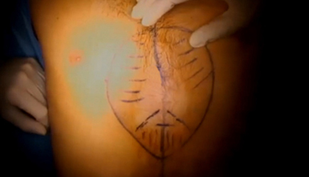 Foto del inicio de la cirugía de Pectus con dibujo preoperatorio Foto del inicio de la cirugía de Pectus con dibujo preoperatorio