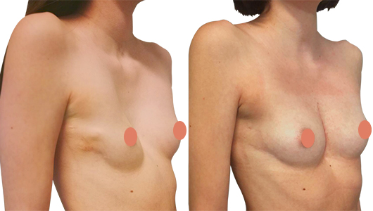 Fotos antes y después de la operación del Pectus Excavatum mujer Fotos antes y después de la operación del Pectus Excavatum mujer