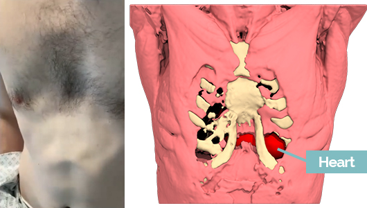 Fracaso de Ravitch para la corrección de un Pectus Excavatum con latido del corazón visible en la vida real y en el diseño 3D Fracaso de Ravitch para la corrección de un Pectus Excavatum con latido del corazón visible en la vida real y en el diseño 3D