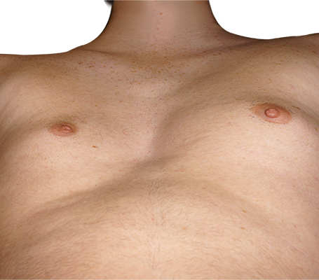 Pectus Excavatum asimétrico y ancho (tipo 3)