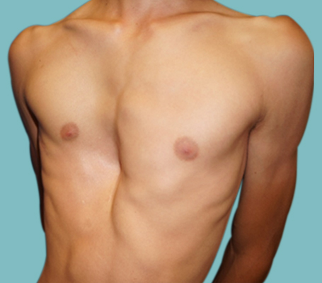 Vista 3D de un Pectus Excavatum con implante