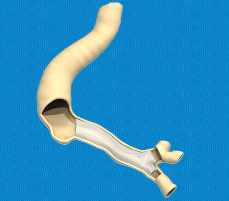 Pro Area - Stent