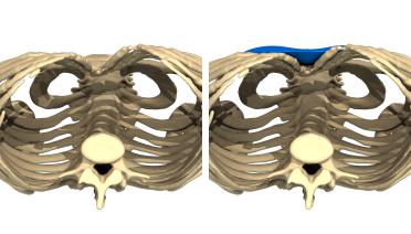 Mujer - Pectus tipo 1 - 3 meses después - vista  3D