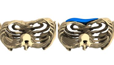 Mujer - Pectus tipo 3 - 3 meses después - vista  3D