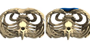 Mujer - Pectus tipo 4 -  1 año después - vista 3D