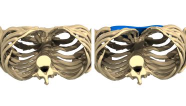 Mujer - Pectus tipo 5 - 2 años después - vista 3D