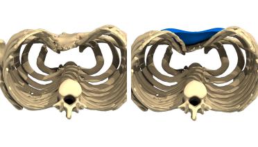 Hombre - Pectus tipo 1 - 1 año después - vista 3D