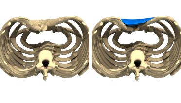 Hombre - Pectus tipo 2 - 3 meses después - vista 3D