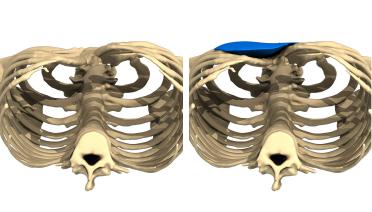 Hombre - Pectus tipo 3 - 3 meses después - vista 3D