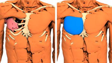Hombre - Poland tipo 4 - 3 meses después - vista 3D